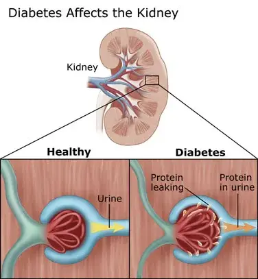 Effects of Diabetes on Kidneys